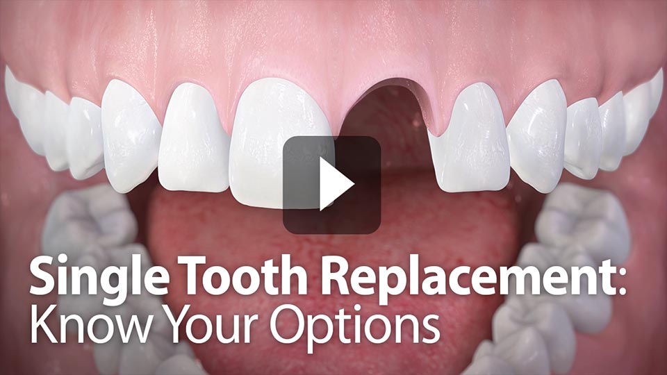 Single Tooth Replacement: Know Your Options